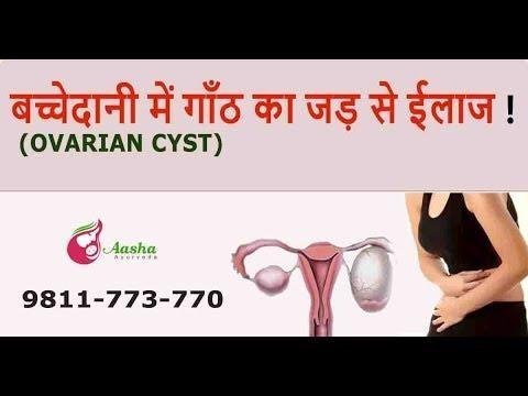 Ovarian Cyst – Symptoms, Causes, And Treatment