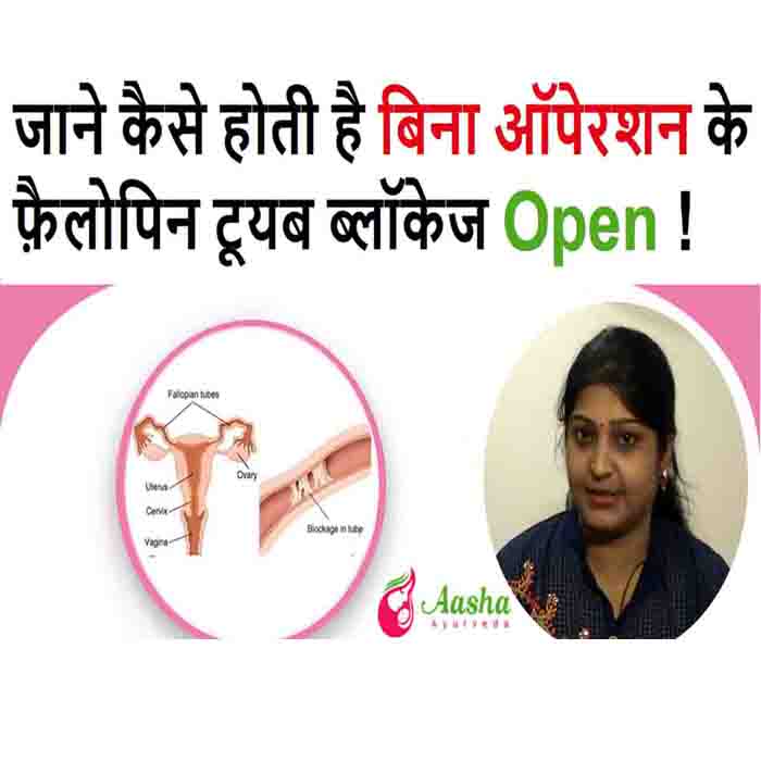 Treatment of Fallopian Tube Blockage Without Surgery