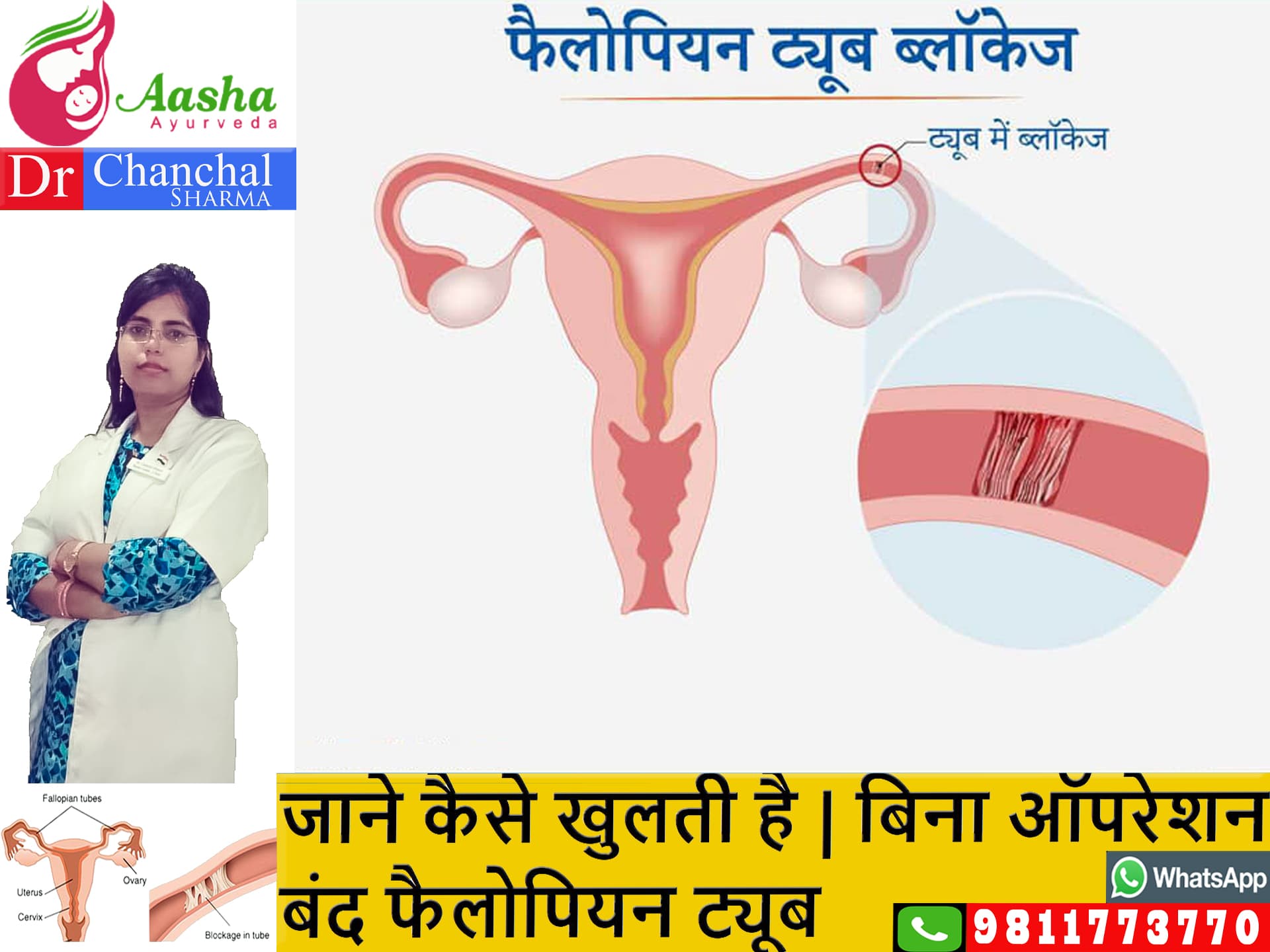 Fallopian Tube Blockage Treatment without Surgery in Hindi