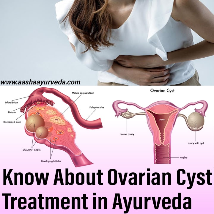 Know About Ovarian Cyst Treatment in ayurveda 