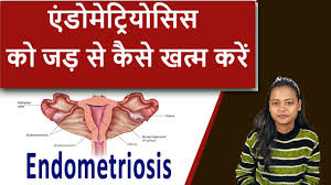 What is Endometriosis and treatment