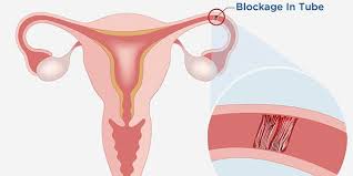 Blocked Fallopian Tube Success Story from Aasha Ayurveda