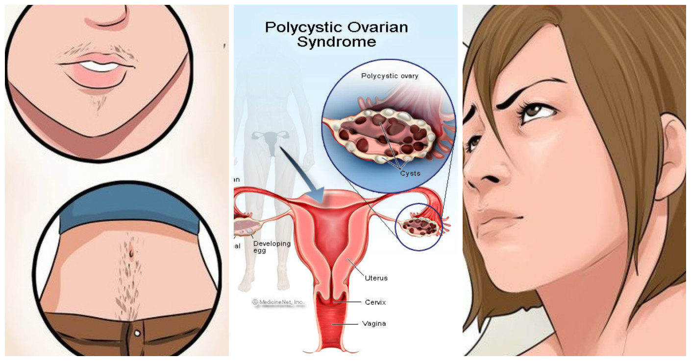 Unwanted hair on face and irregular periods sign of PCOS