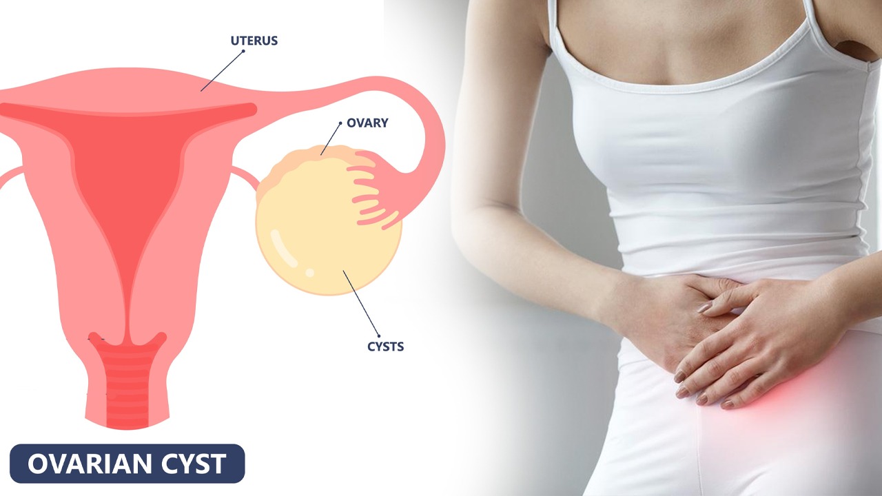 Uterus Cyst in Hindi Aasha Ayurveda