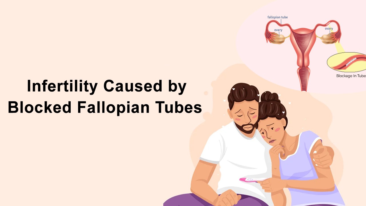 Infertility caused by blocked fallopian tubes 