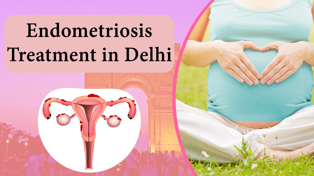 Comprehensive Guide to Endometriosis Treatment in Delhi