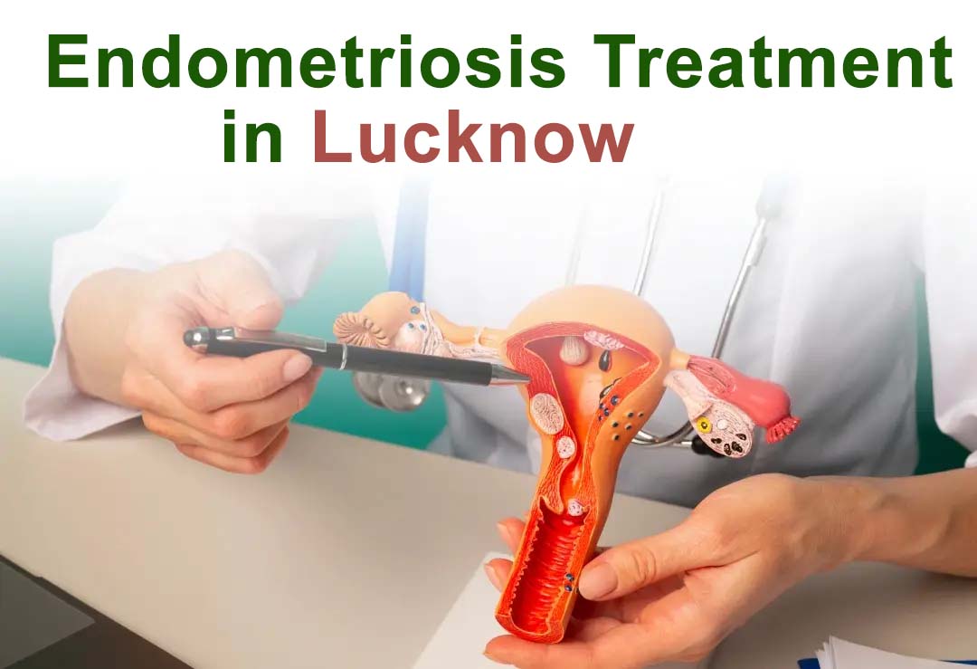 Best Endometriosis treatment Centre in Lucknow